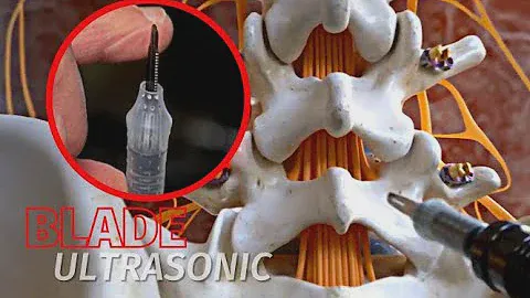 World's Most Precise Bone-Cutting Blade